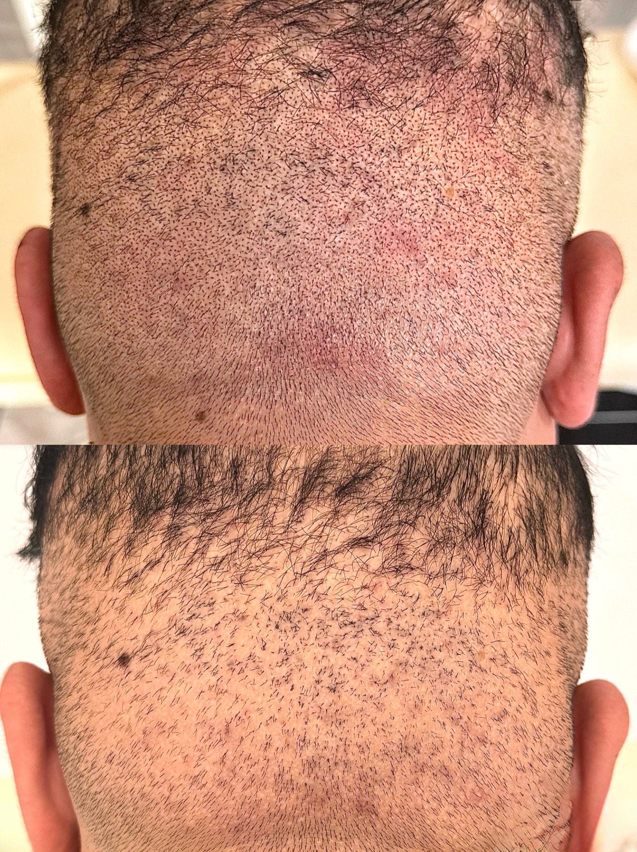 Scalp Micropigmentation CPD Training Course Package 2