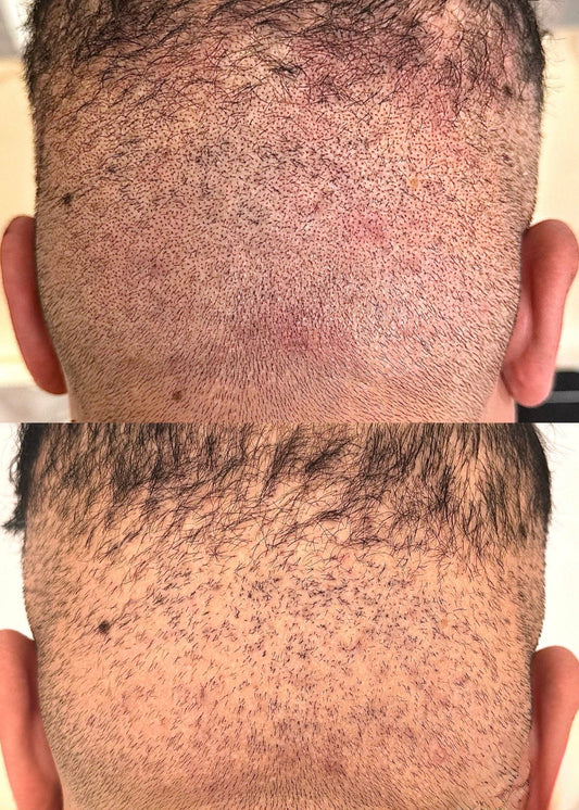 CPD to VTCT Skills (ITEC) Level 4 Award in Scalp Micropigmentation Treatment Conversion | SMP Qualification London | Pigment Lab