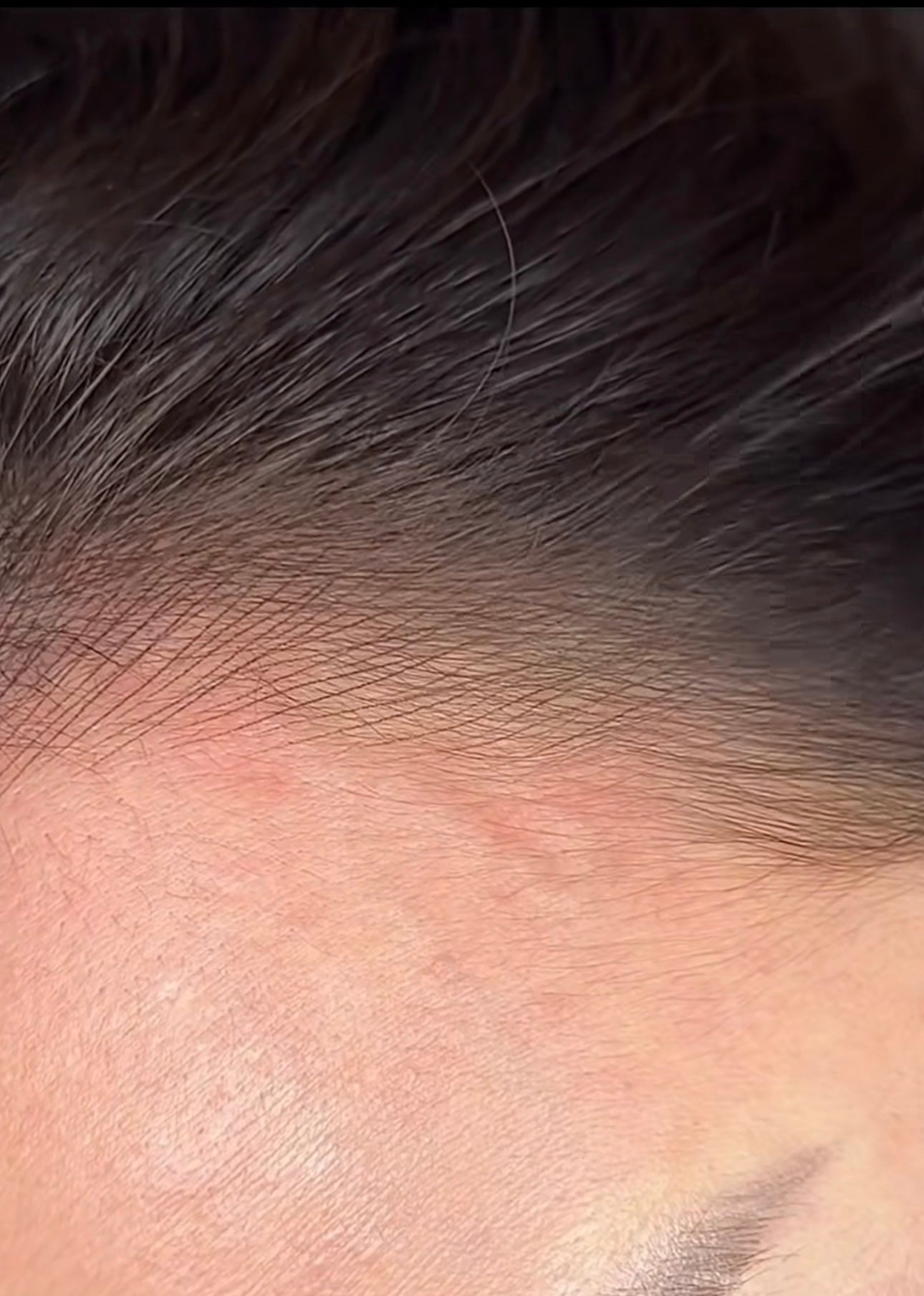 VTCT Skills (ITEC) Level 4 Award in Scalp Micropigmentation Treatment