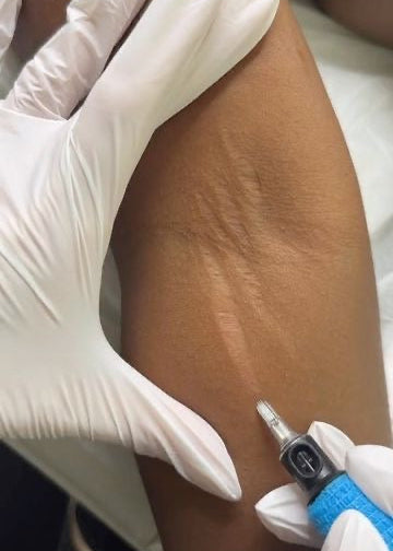 VTCT Skills (ITEC) Level 5 Award in Micropigmentation for Camouflage and Restoration