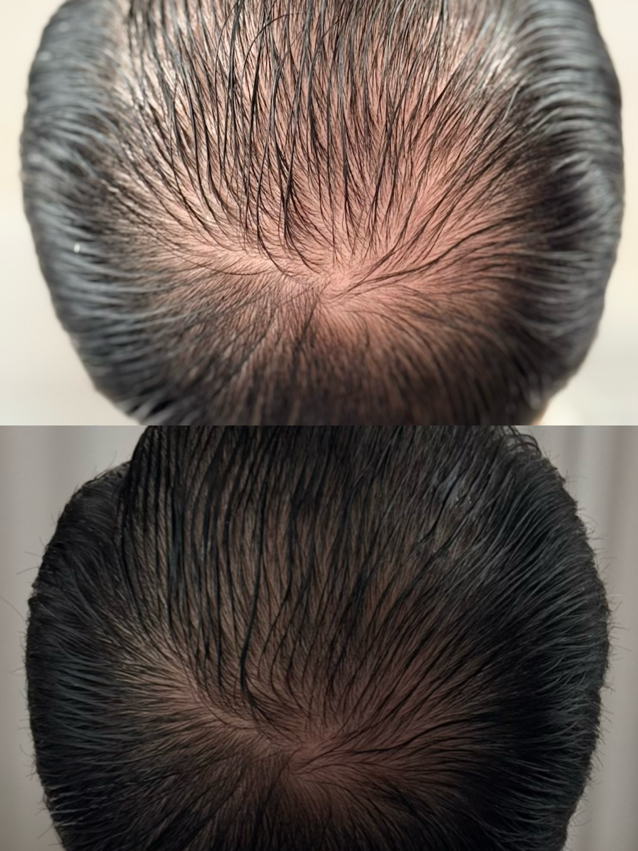VTCT Skills (ITEC) Level 4 Award in Scalp Micropigmentation Treatment